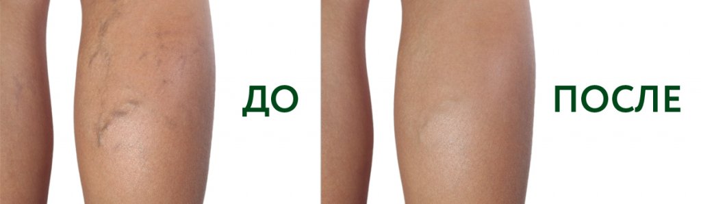 флебология 2.jpg
